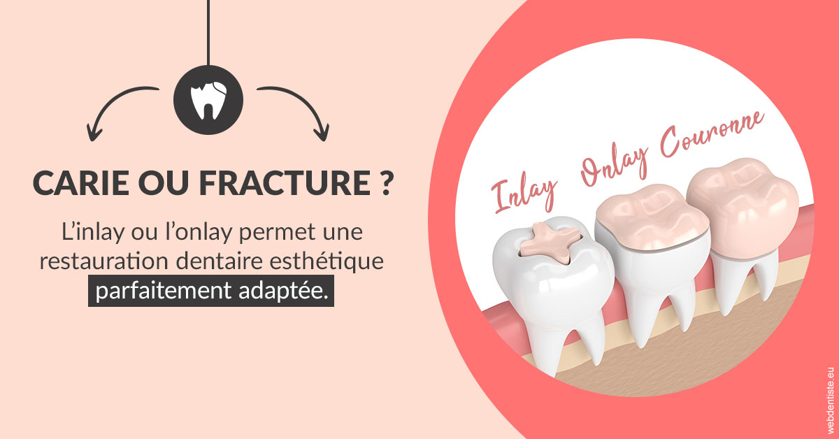 https://www.dr-alain-siegwart-dentiste.fr/T2 2023 - Carie ou fracture 2