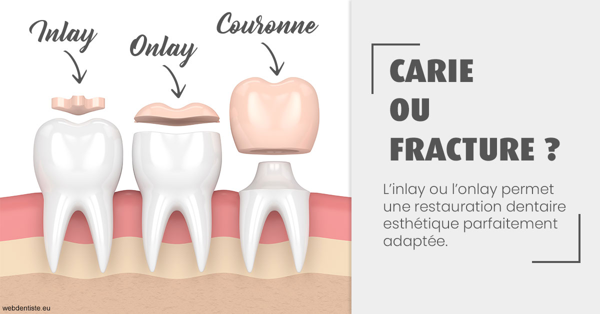 https://www.dr-alain-siegwart-dentiste.fr/T2 2023 - Carie ou fracture 1