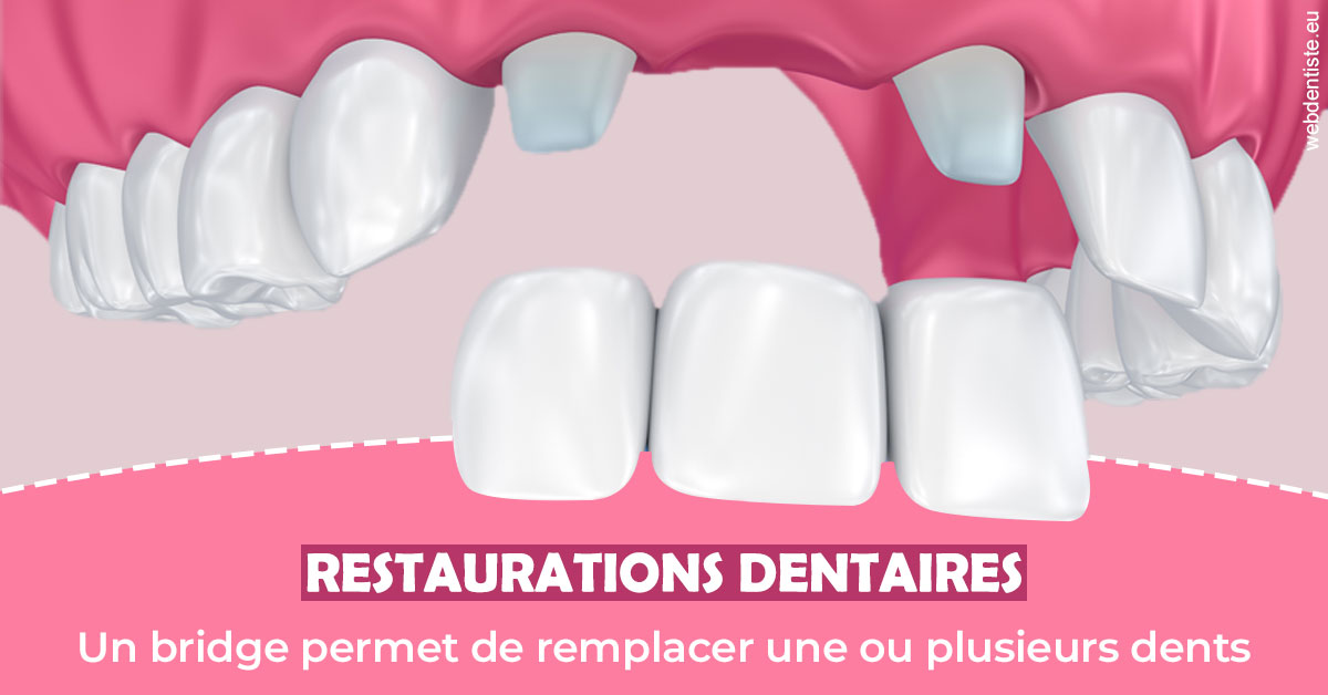 https://www.dr-alain-siegwart-dentiste.fr/Bridge remplacer dents 2