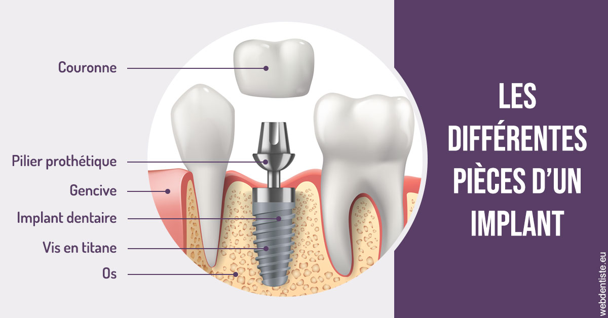 https://www.dr-alain-siegwart-dentiste.fr/Les différentes pièces d’un implant 2