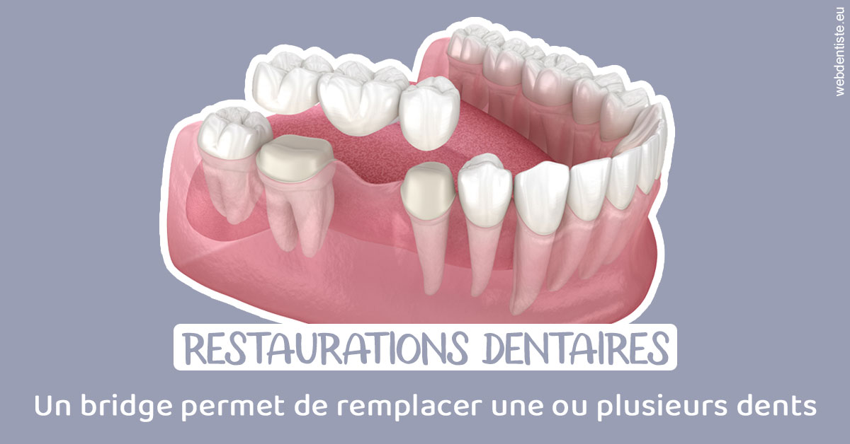 https://www.dr-alain-siegwart-dentiste.fr/Bridge remplacer dents 1