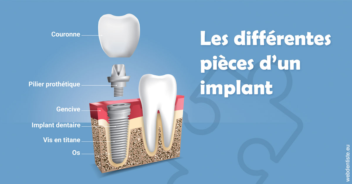 https://www.dr-alain-siegwart-dentiste.fr/Les différentes pièces d’un implant 1
